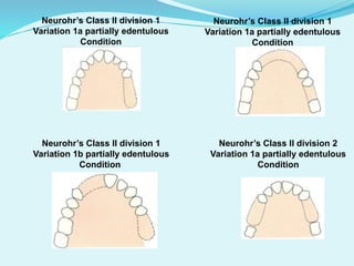 Neurohr’s Class II division 1
Variation 1a partially edentulous
Condition
Neurohr’s Class II division 1
Variation 1a partially edentulous
Condition
Neurohr’s Class II division 1
Variation 1b partially edentulous
Condition
Neurohr’s Class II division 2
Variation 1a partially edentulous
Condition
 