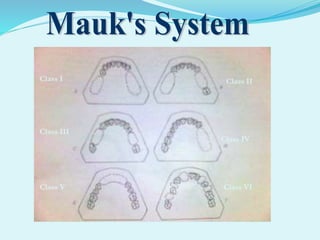 Class I Class II
Class III
Class IV
Class V Class VI
 