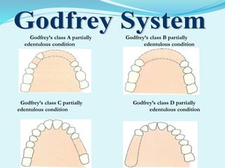 Godfrey’s class A partially Godfrey’s class B partially
edentulous condition edentulous condition
Godfrey’s class C partially Godfrey’s class D partially
edentulous condition edentulous condition
 