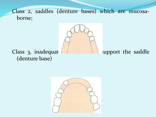 Class 2, saddles (denture bases) which are mucosa-
borne;
Class 3, inadequate abutments to support the saddle
(denture base)
 