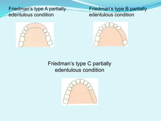 Friedman’s type A partially Friedman’s type B partially
edentulous condition edentulous condition
Friedman’s type C partially
edentulous condition
 
