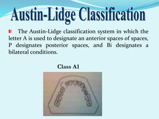 The Austin-Lidge classification system in which the
letter A is used to designate an anterior spaces of spaces,
P designates posterior spaces, and Bi designates a
bilateral conditions.
Class A1
 