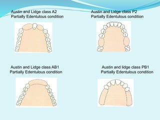 Austin and Lidge class A2 Austin and Lidge class P2
Partially Edentulous condition Partially Edentulous condition
Austin and Lidge class AB1 Austin and lidge class PB1
Partially Edentulous condition Partially Edentulous condition
 