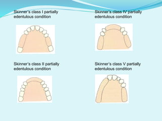 Skinner’s class I partially Skinner’s class IV partially
edentulous condition edentulous condition
Skinner’s class II partially Skinner’s class V partially
edentulous condition edentulous condition
 