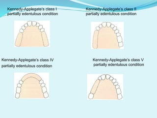 Kennedy-Applegate’s class I Kennedy-Applegate’s class II
partially edentulous condition partially edentulous condition
Kennedy-Applegate’s class V
partially edentulous condition
 