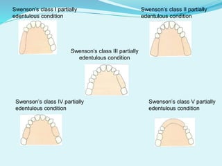 Swenson’s class I partially Swenson’s class II partially
edentulous condition edentulous condition
Swenson’s class III partially
edentulous condition
Swenson’s class IV partially Swenson’s class V partially
edentulous condition edentulous condition
 