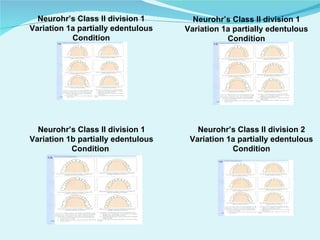 Frs Rpd Classsification of rpd | PPT