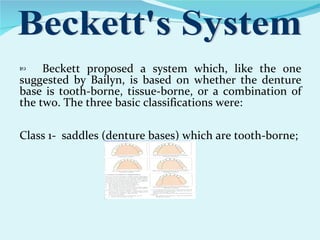 Classsification of rpd | PPT