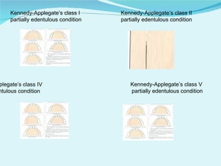 Applegate's Rules.pdf Classsification of rpd | PPT