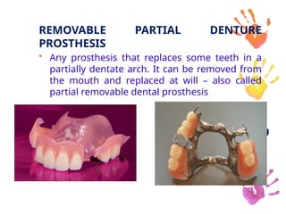 REMOVABLE PARTIAL DENTURE
PROSTHESIS
• Any prosthesis that replaces some teeth in a
partially dentate arch. It can be removed from
the mouth and replaced at will – also called
partial removable dental prosthesis
 