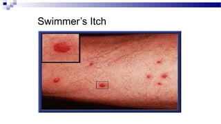 Swimmer’s Itch
 