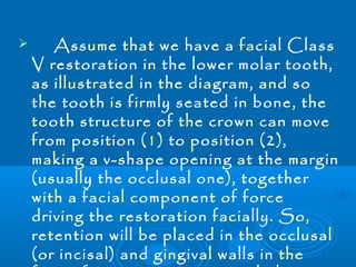  Assume that we have a facial Class 
V restoration in the lower molar tooth, 
as illustrated in the diagram, and so 
the tooth is firmly seated in bone, the 
tooth structure of the crown can move 
from position (1) to position (2), 
making a v-shape opening at the margin 
(usually the occlusal one), together 
with a facial component of force 
driving the restoration facially. So, 
retention will be placed in the occlusal 
(or incisal) and gingival walls in the 
form of grooves or retentive holes. 
 