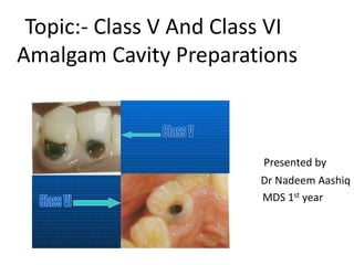 Topic:- Class V And Class VI
Amalgam Cavity Preparations
Presented by
Dr Nadeem Aashiq
MDS 1st year
 