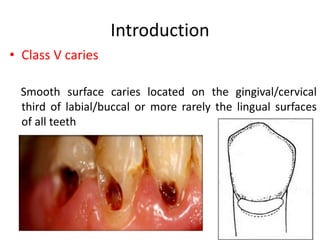 Introduction
• Class V caries
Smooth surface caries located on the gingival/cervical
third of labial/buccal or more rarely...