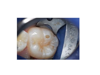 • For class VI amalgam preparations, the dentists enters the area
with a small tapered fissure bur (e.g., No 169L) and ext...