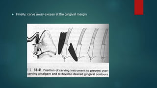  Finally, carve away excess at the gingival margin
 