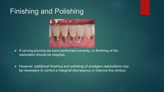 Finishing and Polishing
 If carving procedures were performed correctly, no finishing of the
restoration should be required.
 However ,additional finishing and polishing of amalgam restorations may
be necessary to correct a marginal discrepancy or improve the contour.
 