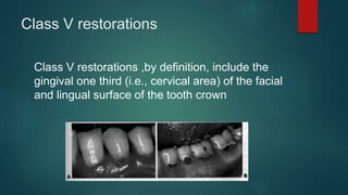 Class V restorations
Class V restorations ,by definition, include the
gingival one third (i.e., cervical area) of the facial
and lingual surface of the tooth crown
 