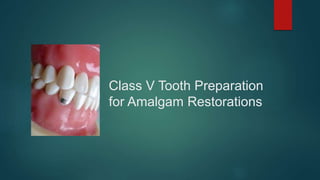 Class V Tooth Preparation
for Amalgam Restorations
 