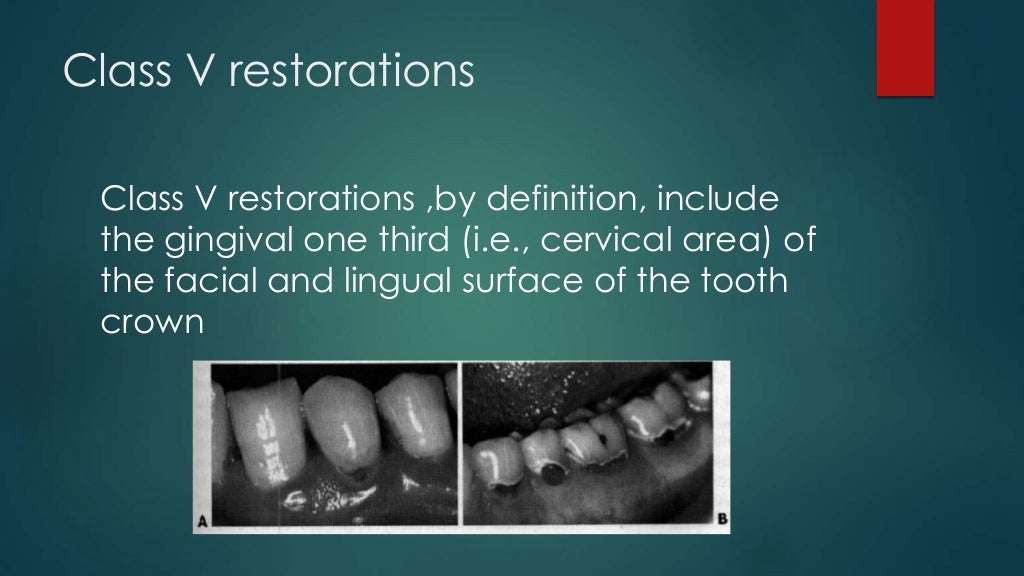 Class v tooth preparation for amalgam restorations