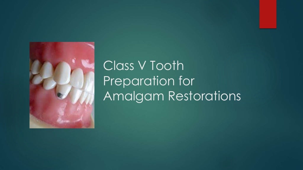 Class v tooth preparation for amalgam restorations
