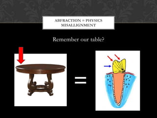ABFRACTION = PHYSICS
  MISALLIGNMENT


Remember our table?




       =
 