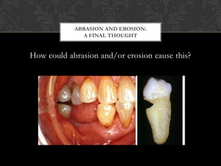 ABRASION AND EROSION:
              A FINAL THOUGHT


How could abrasion and/or erosion cause this?
 