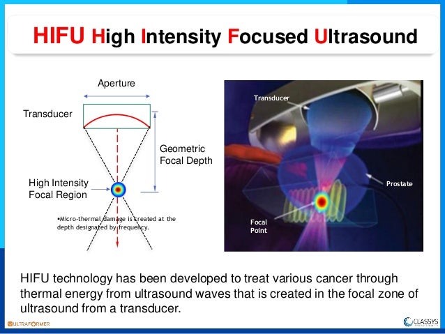 ultrasound cancer high for prostate frequency Tara Classys Hifu Green ultra former TMV ultrasound cancer high for prostate frequency Tara Classys Hifu Green ultra former TMV