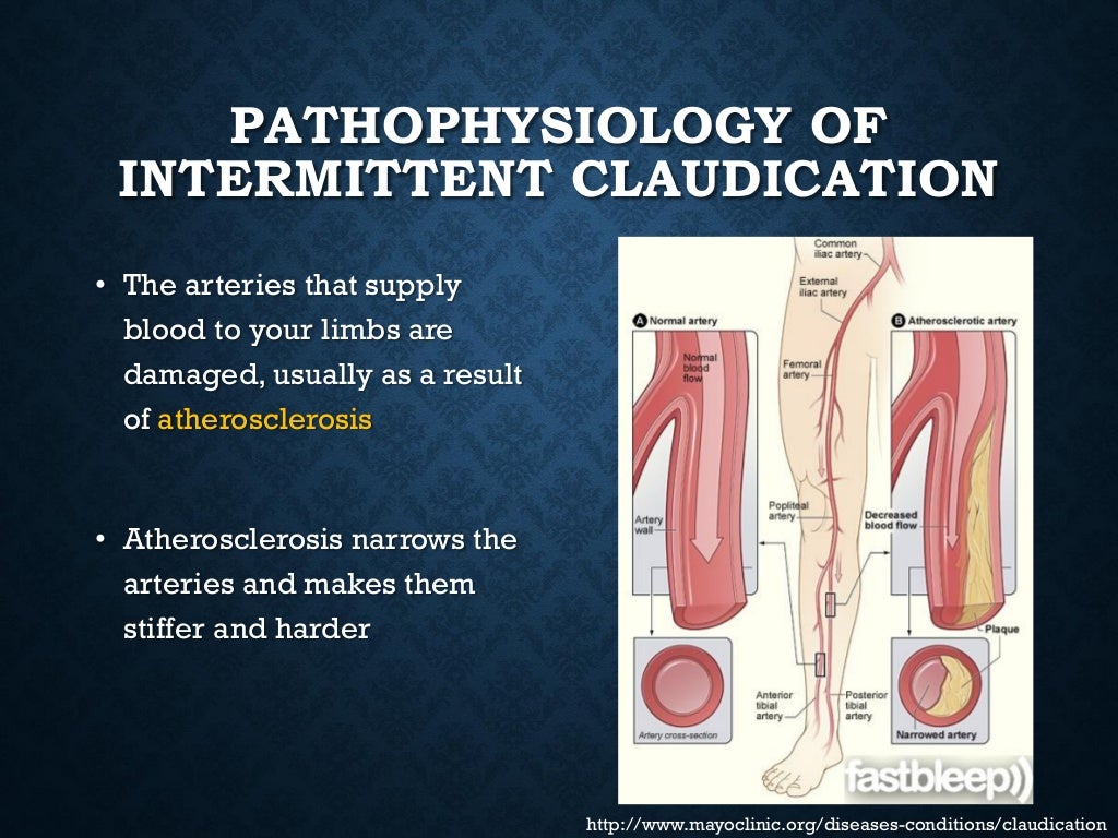 Topic of Vascular Claudication