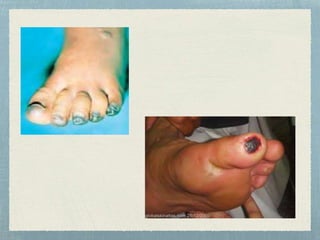 Claudication Rash Claudication in young patients | PPTX
