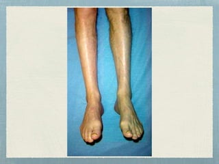 Claudication Rash Claudication in young patients | PPTX