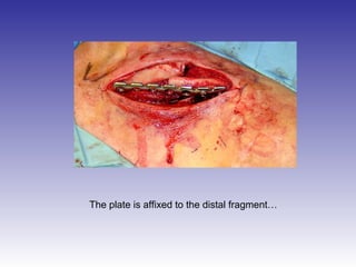 The plate is affixed to the distal fragment… 
 