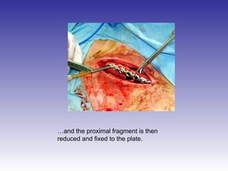 …and the proximal fragment is then 
reduced and fixed to the plate. 
 