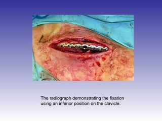 The radiograph demonstrating the fixation 
using an inferior position on the clavicle. 
 