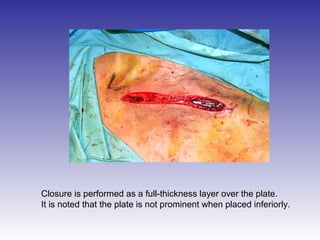 Closure is performed as a full-thickness layer over the plate. 
It is noted that the plate is not prominent when placed inferiorly. 
 