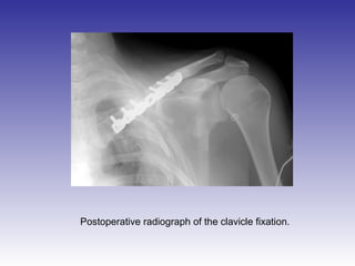 Postoperative radiograph of the clavicle fixation. 
