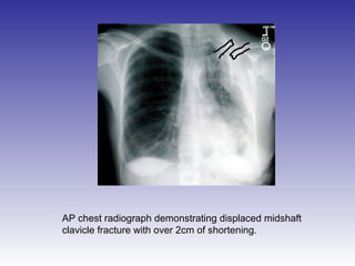 AP chest radiograph demonstrating displaced midshaft 
clavicle fracture with over 2cm of shortening. 
 