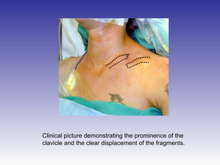 Clinical picture demonstrating the prominence of the 
clavicle and the clear displacement of the fragments. 
 