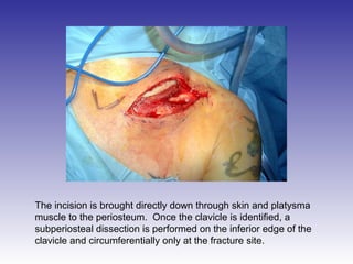The incision is brought directly down through skin and platysma 
muscle to the periosteum. Once the clavicle is identified, a 
subperiosteal dissection is performed on the inferior edge of the 
clavicle and circumferentially only at the fracture site. 
 