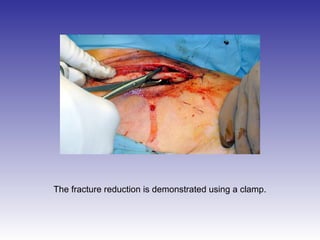 The fracture reduction is demonstrated using a clamp. 
 