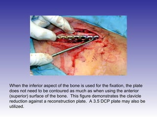 When the inferior aspect of the bone is used for the fixation, the plate 
does not need to be contoured as much as when using the anterior 
(superior) surface of the bone. This figure demonstrates the clavicle 
reduction against a reconstruction plate. A 3.5 DCP plate may also be 
utilized. 
 