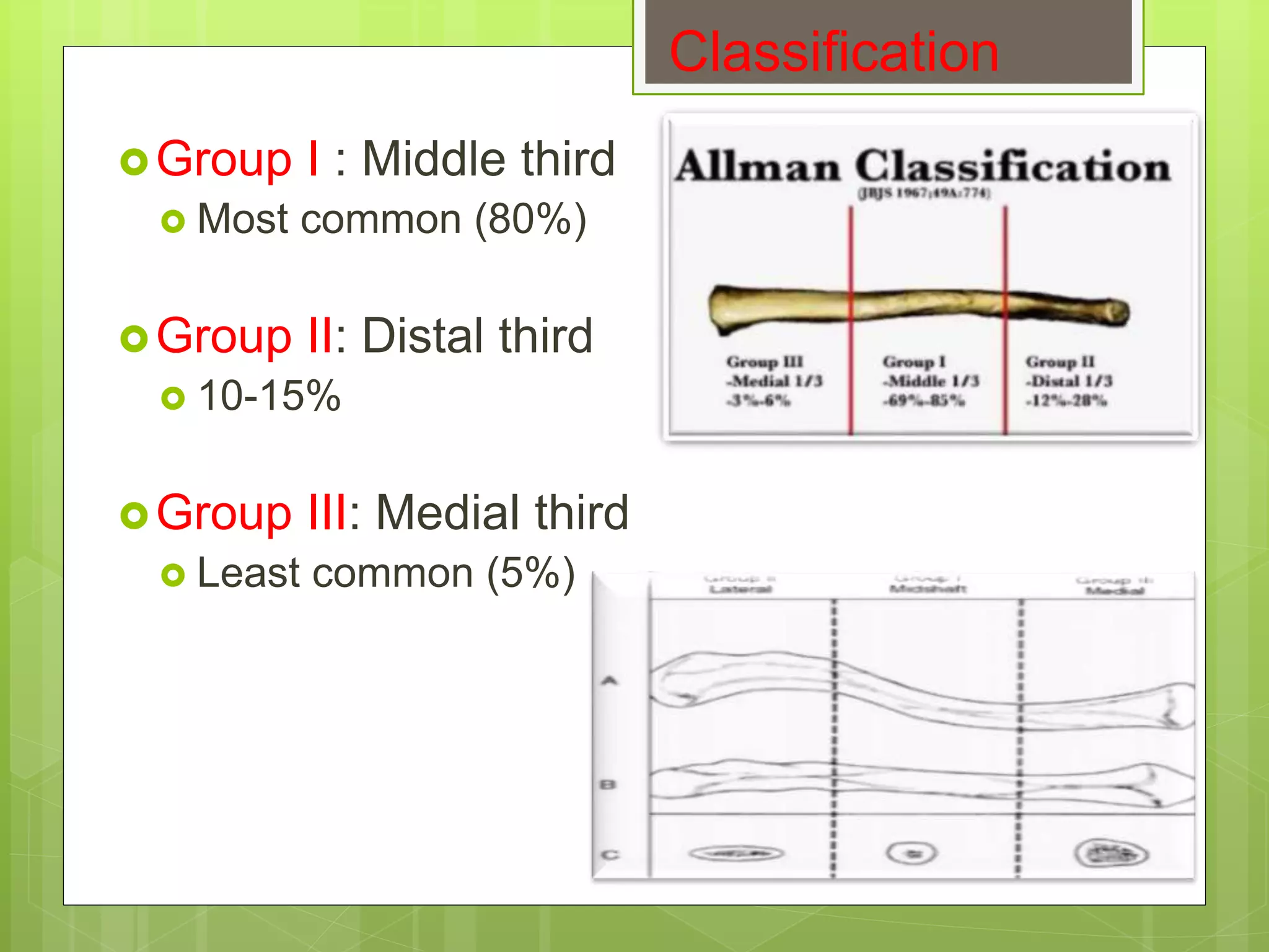Clavicle Fracture | PPTX