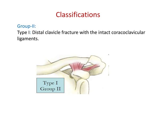 Clavicle and scapular fracture | PPTX