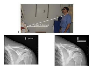 CLAVICLE, ACJ and SCJ radiographic technique.pptx