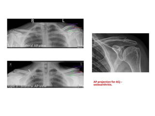 CLAVICLE, ACJ and SCJ radiographic technique.pptx