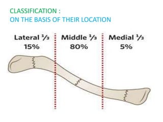 Clavicle fracture | PPTX