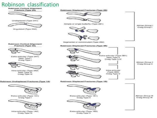 clavicle fracture clavicle fracture