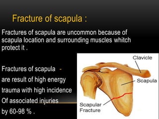 Clavicle fracture | PPTX
