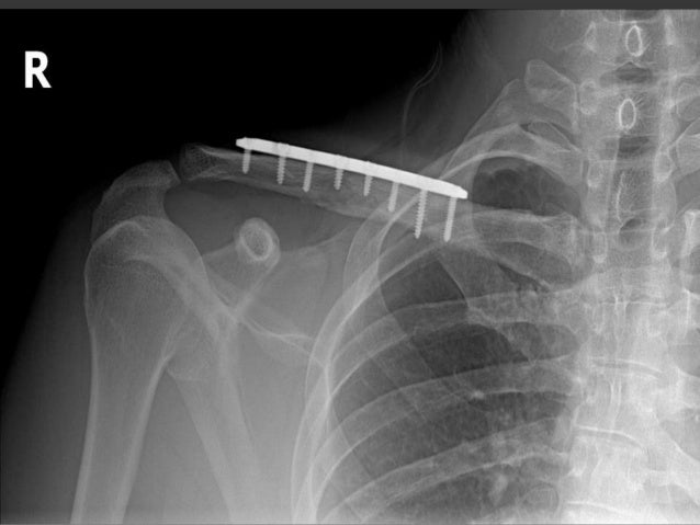 Clavicle fracture