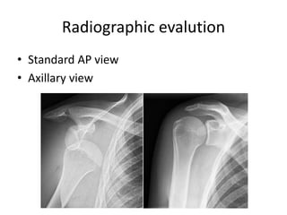 Clavicle fracture & injuries around shoulder | PPTX